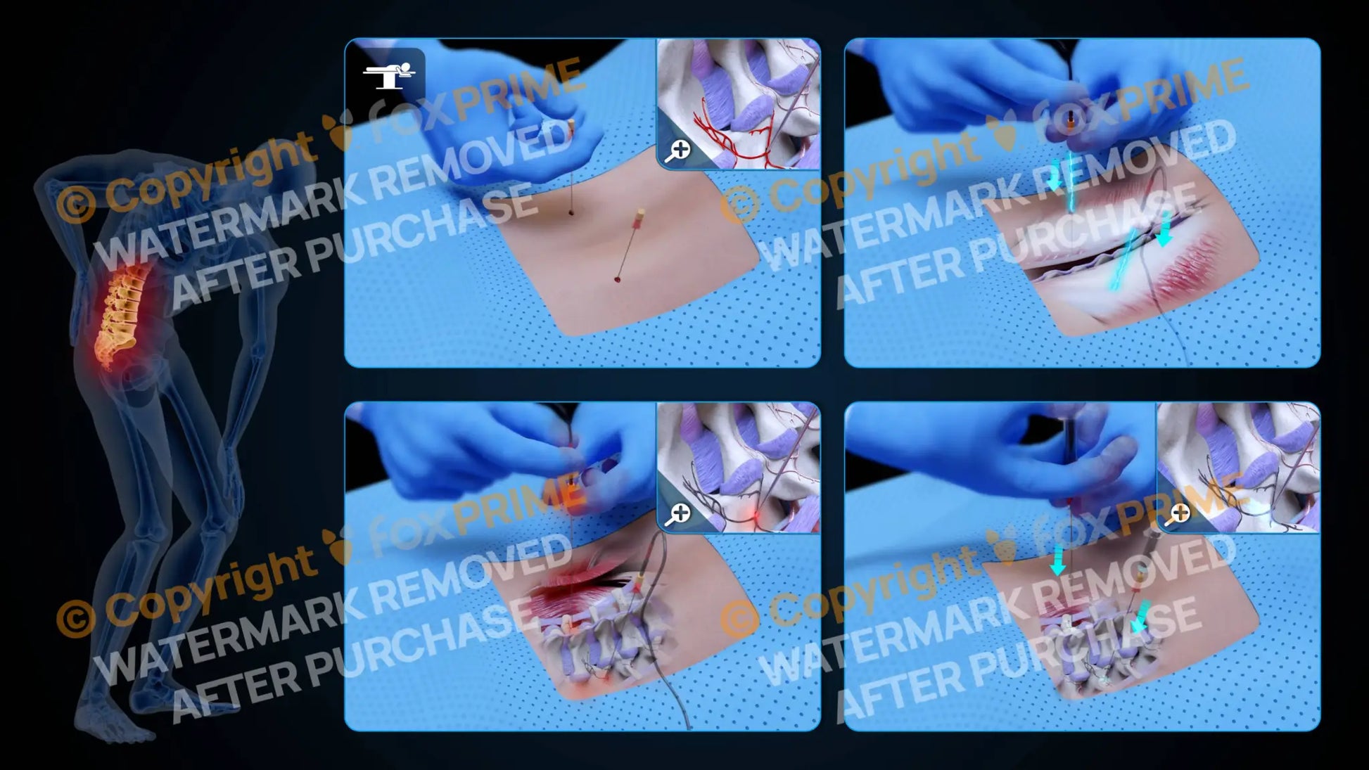 Bilateral Radiofrequency Ablation L3-L4 (No Text) - Still Shot