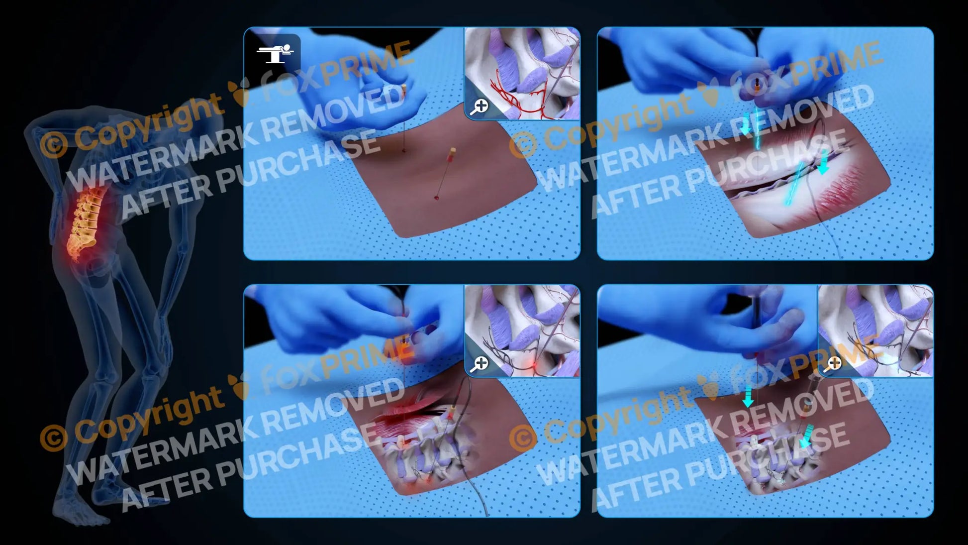 Bilateral Radiofrequency Ablation L3-L4 (No Text) - Still Shot