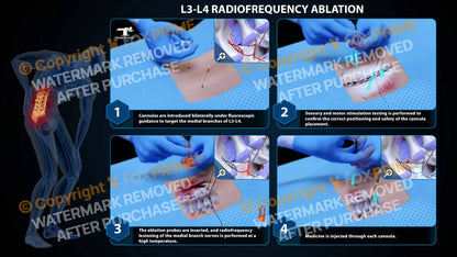 Bilateral Radiofrequency Ablation L3-L4 (PowerPoint) - PowerPoint