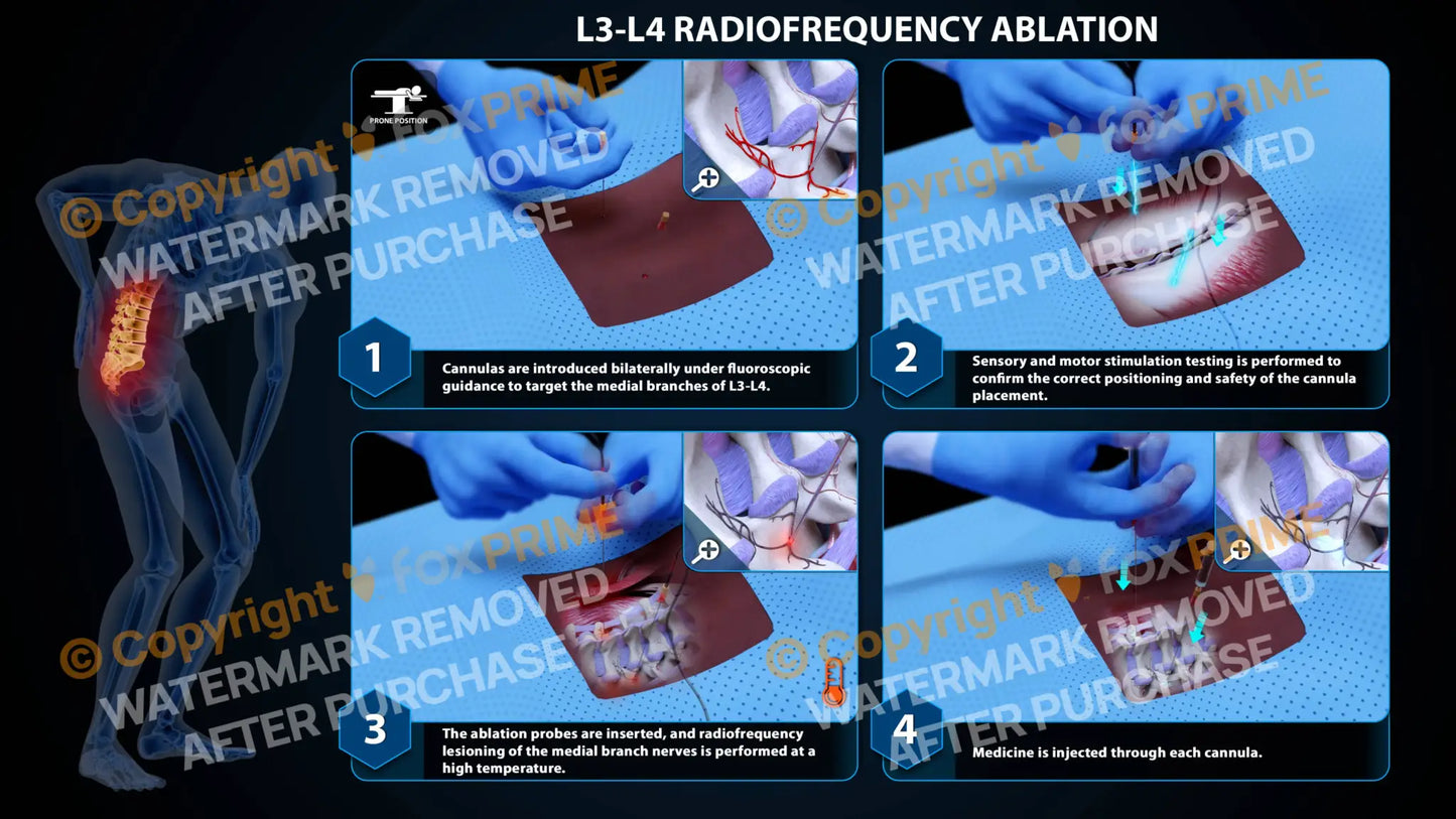 Bilateral Radiofrequency Ablation L3-L4 (PowerPoint) - PowerPoint