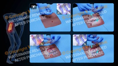 Bilateral Radiofrequency Ablation L4-L5 (No Text) - Still Shot