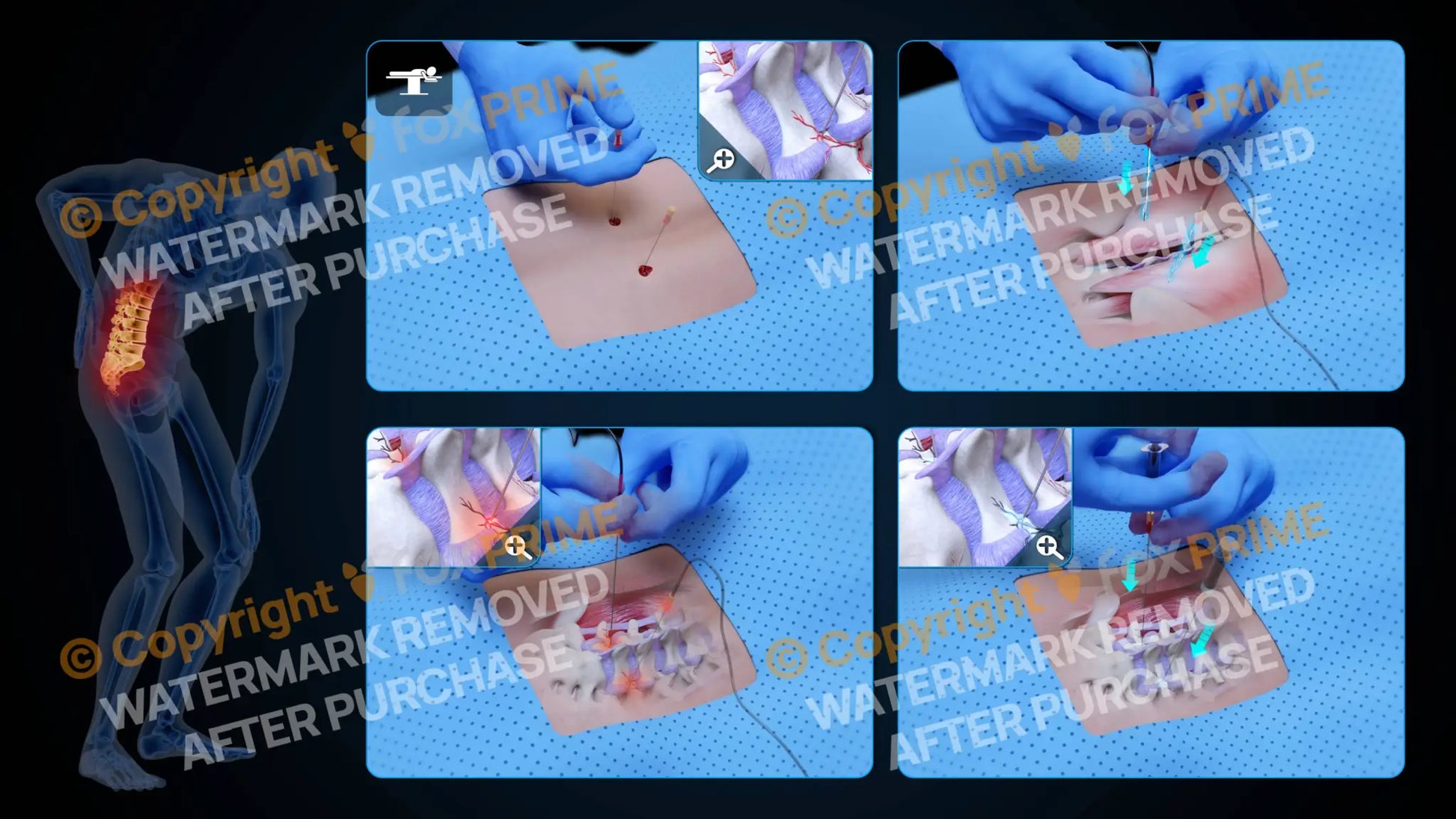 Bilateral Radiofrequency Ablation L4-L5 (No Text) - Still Shot