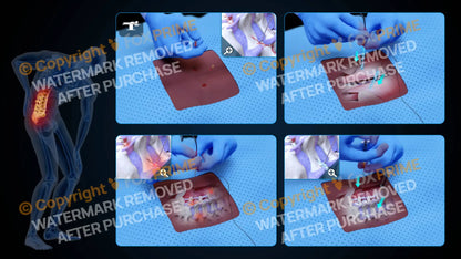 Bilateral Radiofrequency Ablation L4-L5 (No Text) - Still Shot