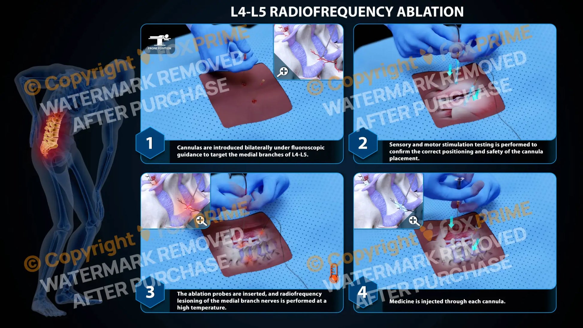 Bilateral Radiofrequency Ablation L4-L5 (PowerPoint) - PowerPoint