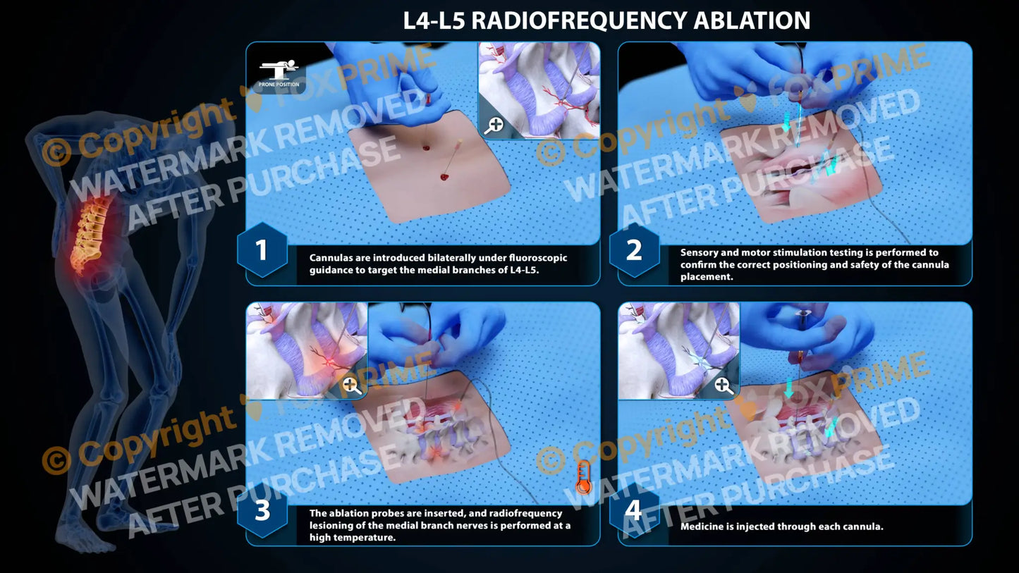Bilateral Radiofrequency Ablation L4-L5 - Still Shot