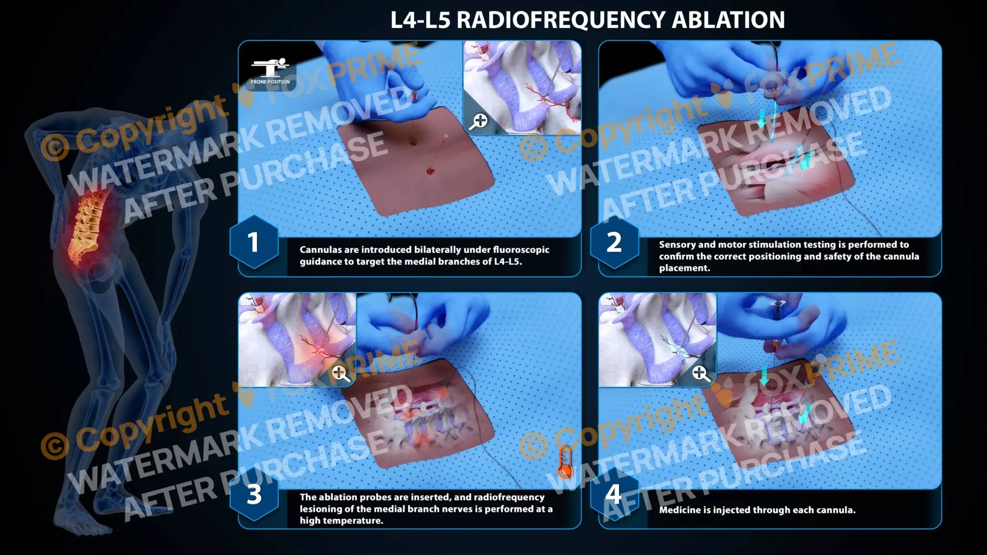 Bilateral Radiofrequency Ablation L4-L5 - Still Shot