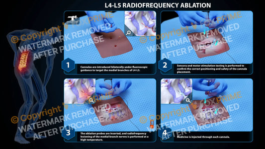 Bilateral Radiofrequency Ablation L4-L5 - Still Shot