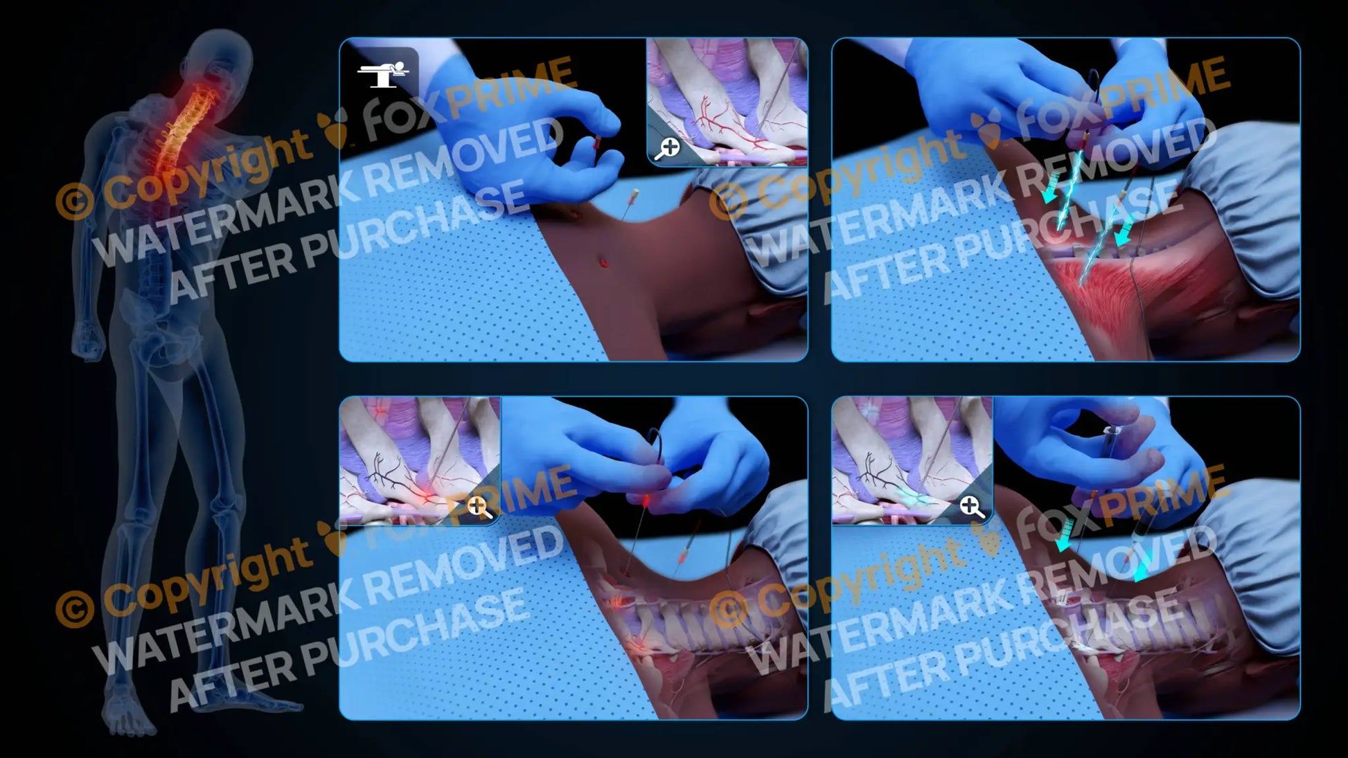 Bilateral Radiofrequency Ablation T1-T2 (No Text) - Still Shot