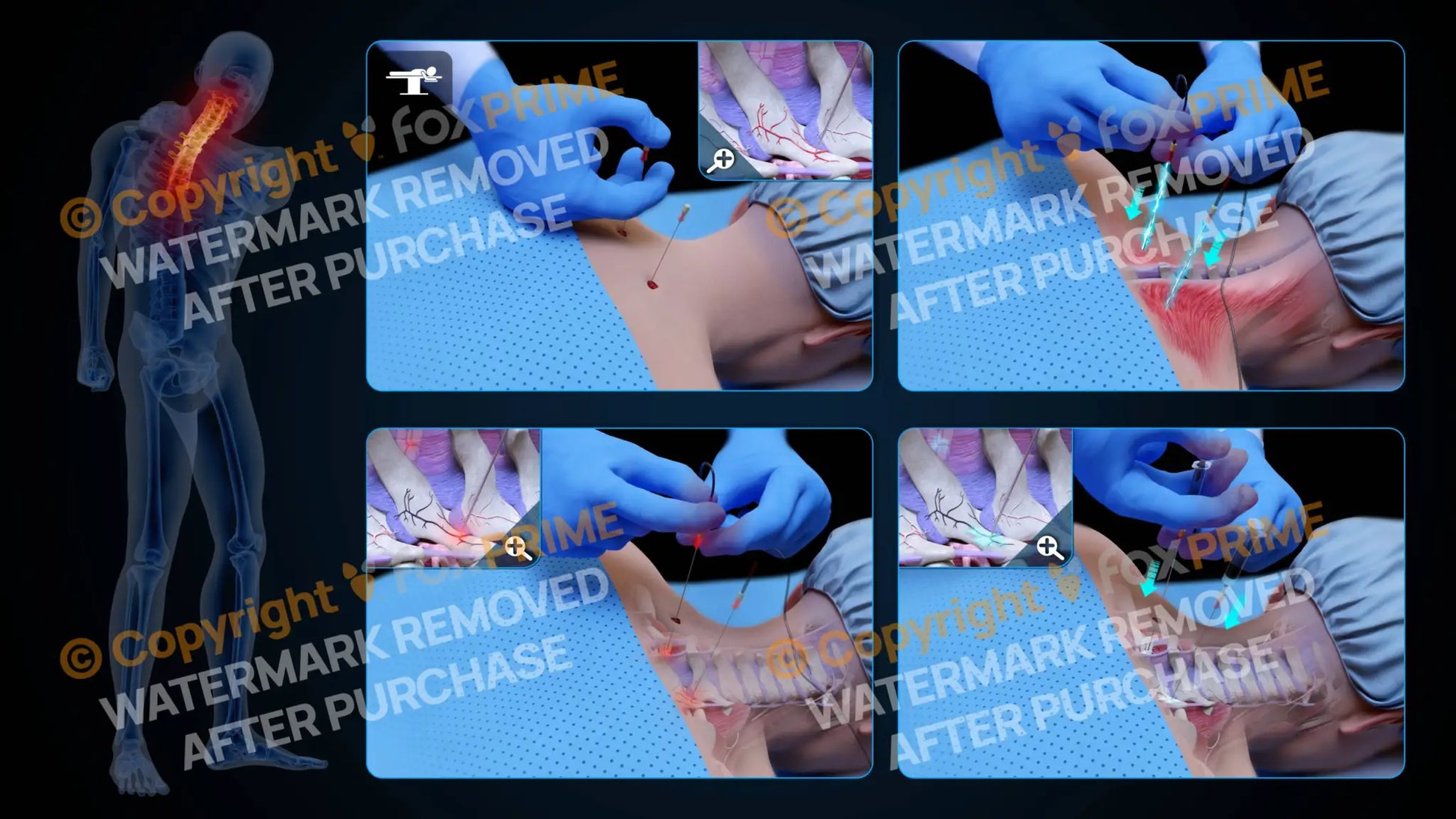 Bilateral Radiofrequency Ablation T1-T2 (No Text) - Still Shot