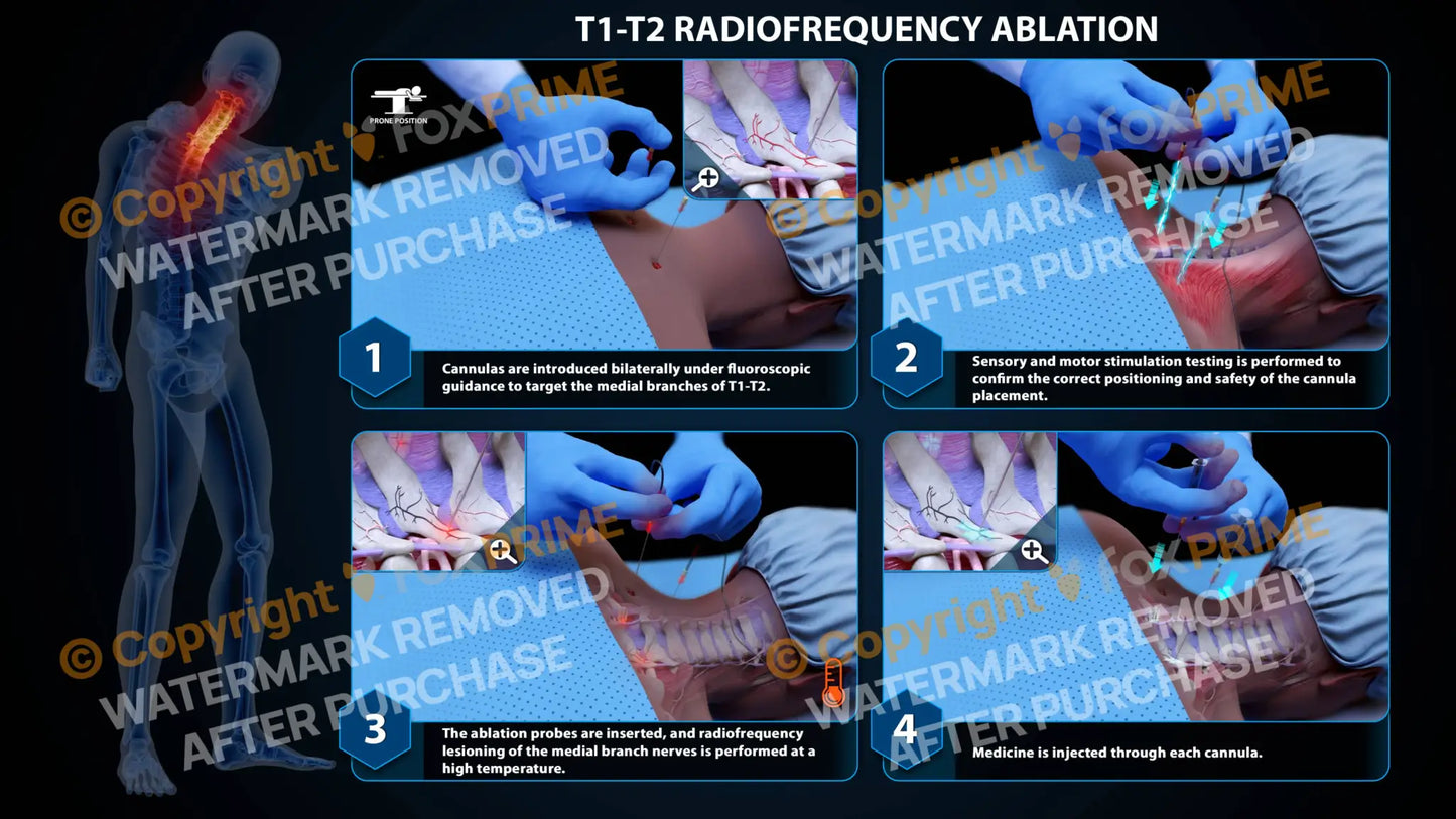 Bilateral Radiofrequency Ablation T1-T2 (PowerPoint) - PowerPoint