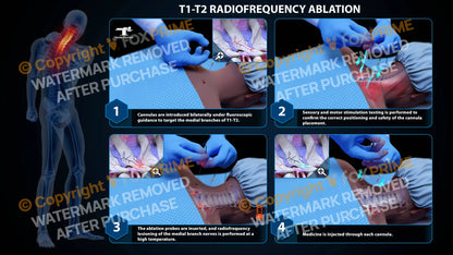 Bilateral Radiofrequency Ablation T1-T2 (PowerPoint) - PowerPoint