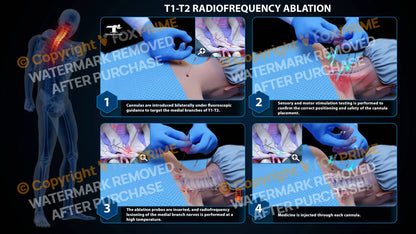 Bilateral Radiofrequency Ablation T1-T2 - Still Shot