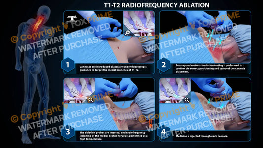 Bilateral Radiofrequency Ablation T1-T2 - Still Shot