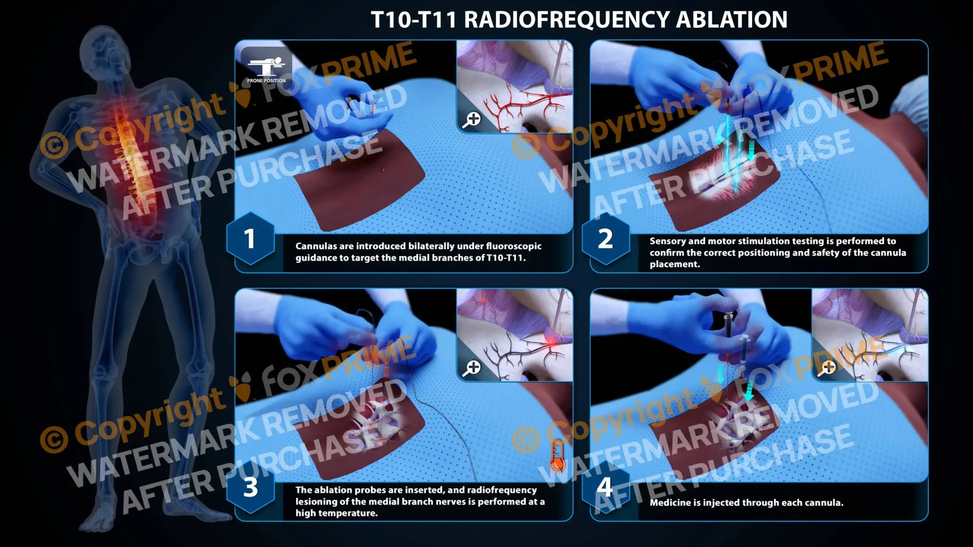 Bilateral Radiofrequency Ablation T10-T11 Still Shot