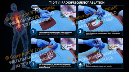 Bilateral Radiofrequency Ablation T10-T11 Still Shot