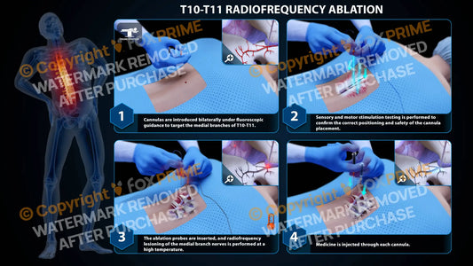 Bilateral Radiofrequency Ablation T10-T11 - Still Shot