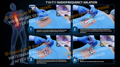 Bilateral Radiofrequency Ablation T10-T11 Still Shot