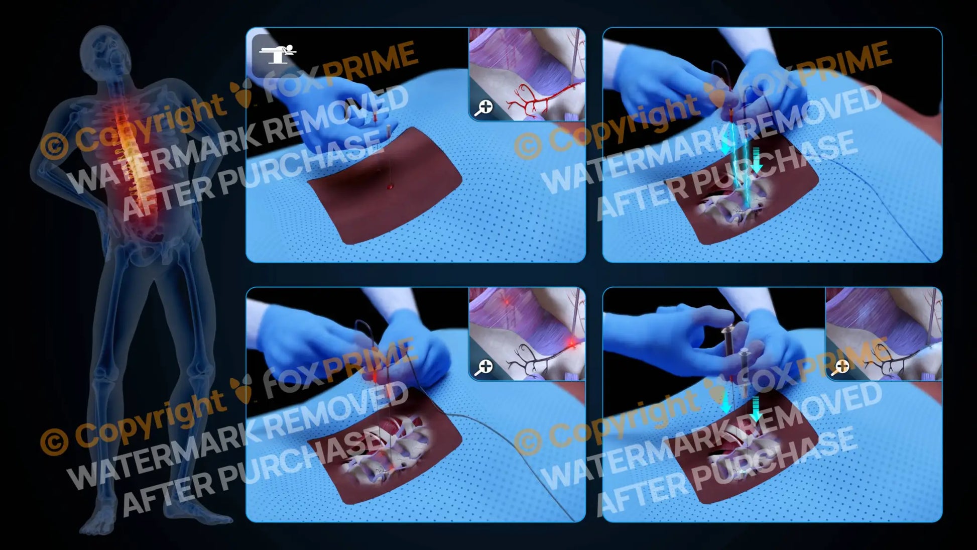 Bilateral Radiofrequency Ablation T11-T12 (No Text) - Still Shot