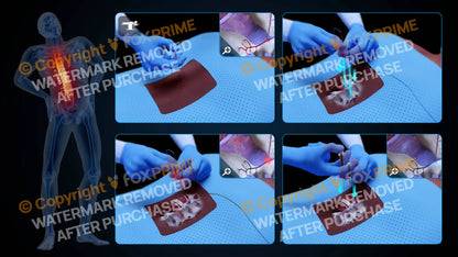 Bilateral Radiofrequency Ablation T11-T12 (No Text) - Still Shot