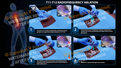 Bilateral Radiofrequency Ablation T11-T12 Still Shot
