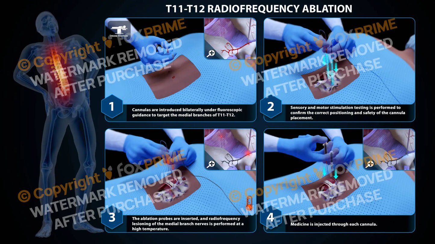 Bilateral Radiofrequency Ablation T11-T12 Still Shot