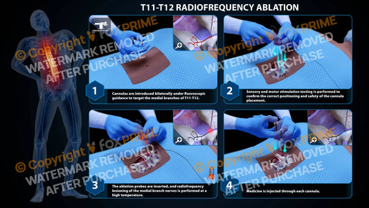 Bilateral Radiofrequency Ablation T11-T12 Still Shot