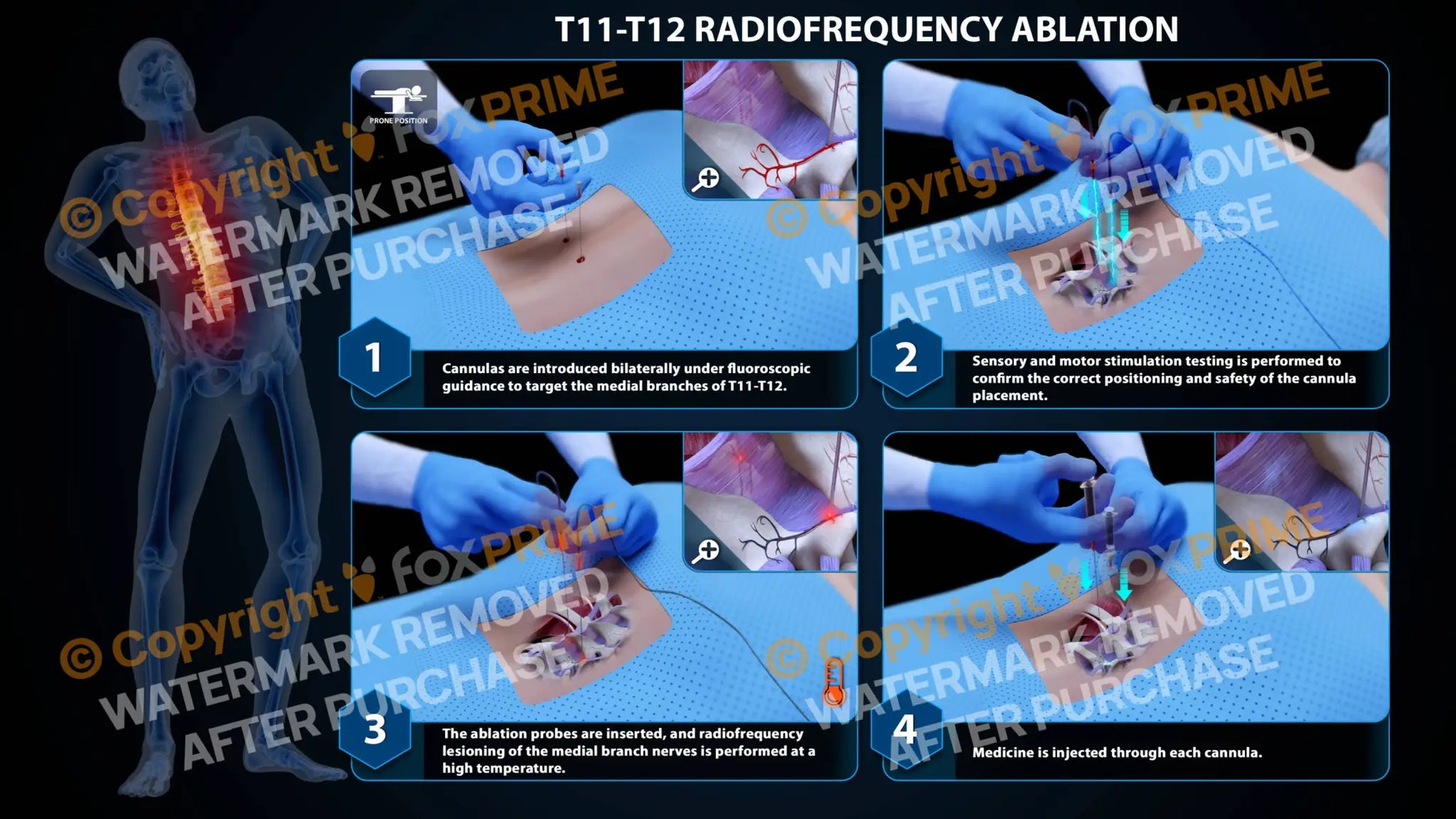 Bilateral Radiofrequency Ablation T11-T12 Still Shot