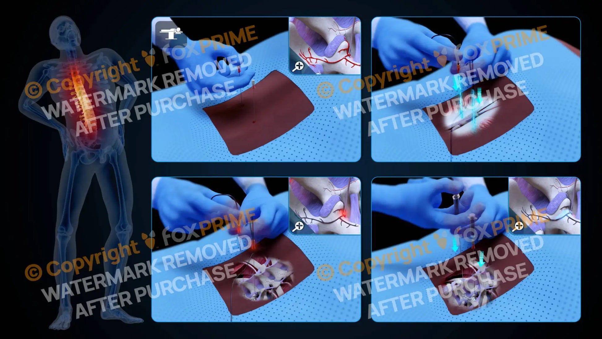 Bilateral Radiofrequency Ablation T12-L1 (No Text) - Still Shot