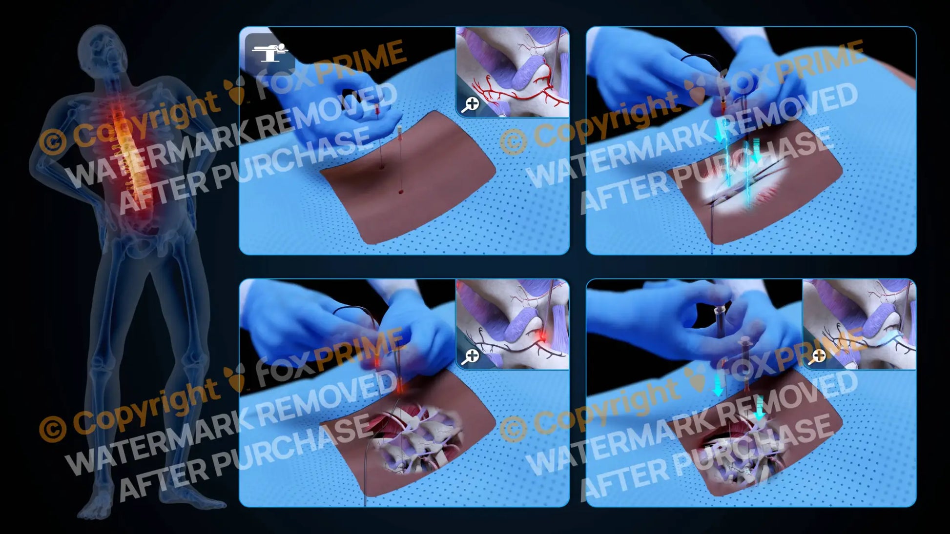 Bilateral Radiofrequency Ablation T12-L1 (No Text) - Still Shot