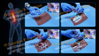 Bilateral Radiofrequency Ablation T12-L1 (No Text) - Still Shot