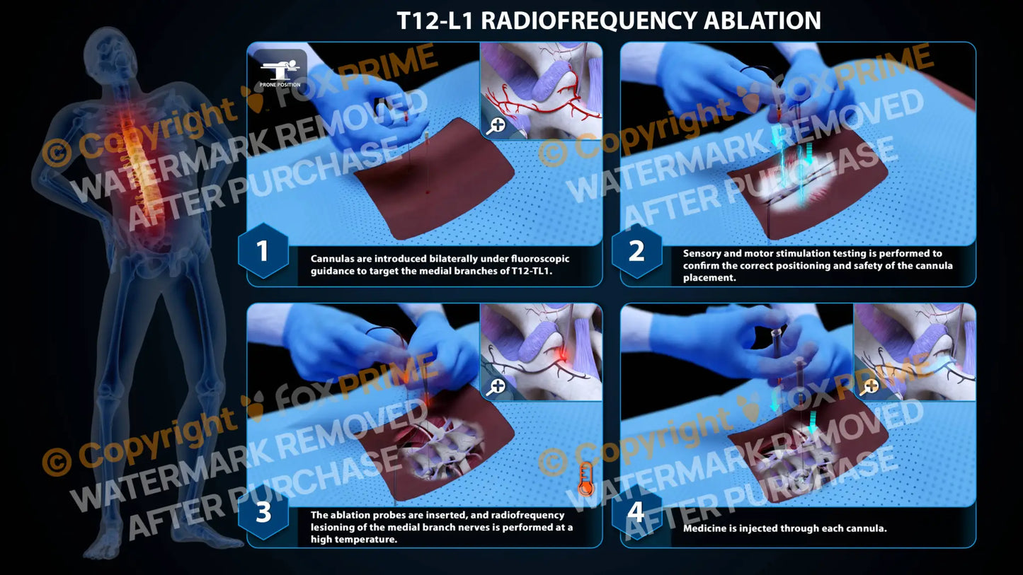 Bilateral Radiofrequency Ablation T12-L1 Still Shot