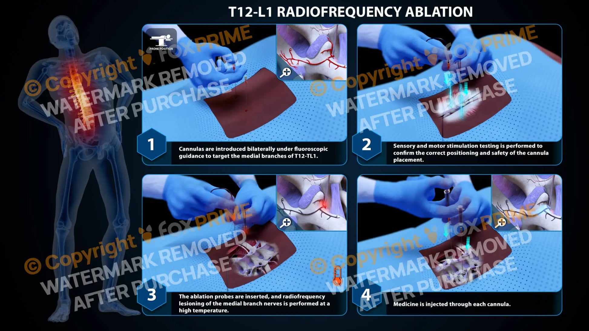 Bilateral Radiofrequency Ablation T12-L1 Still Shot