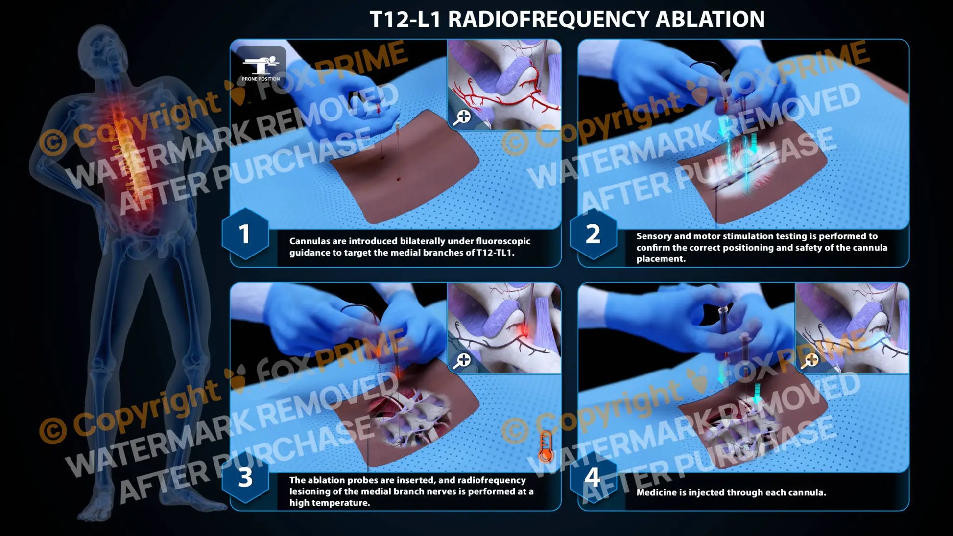 Bilateral Radiofrequency Ablation T12-L1 Still Shot
