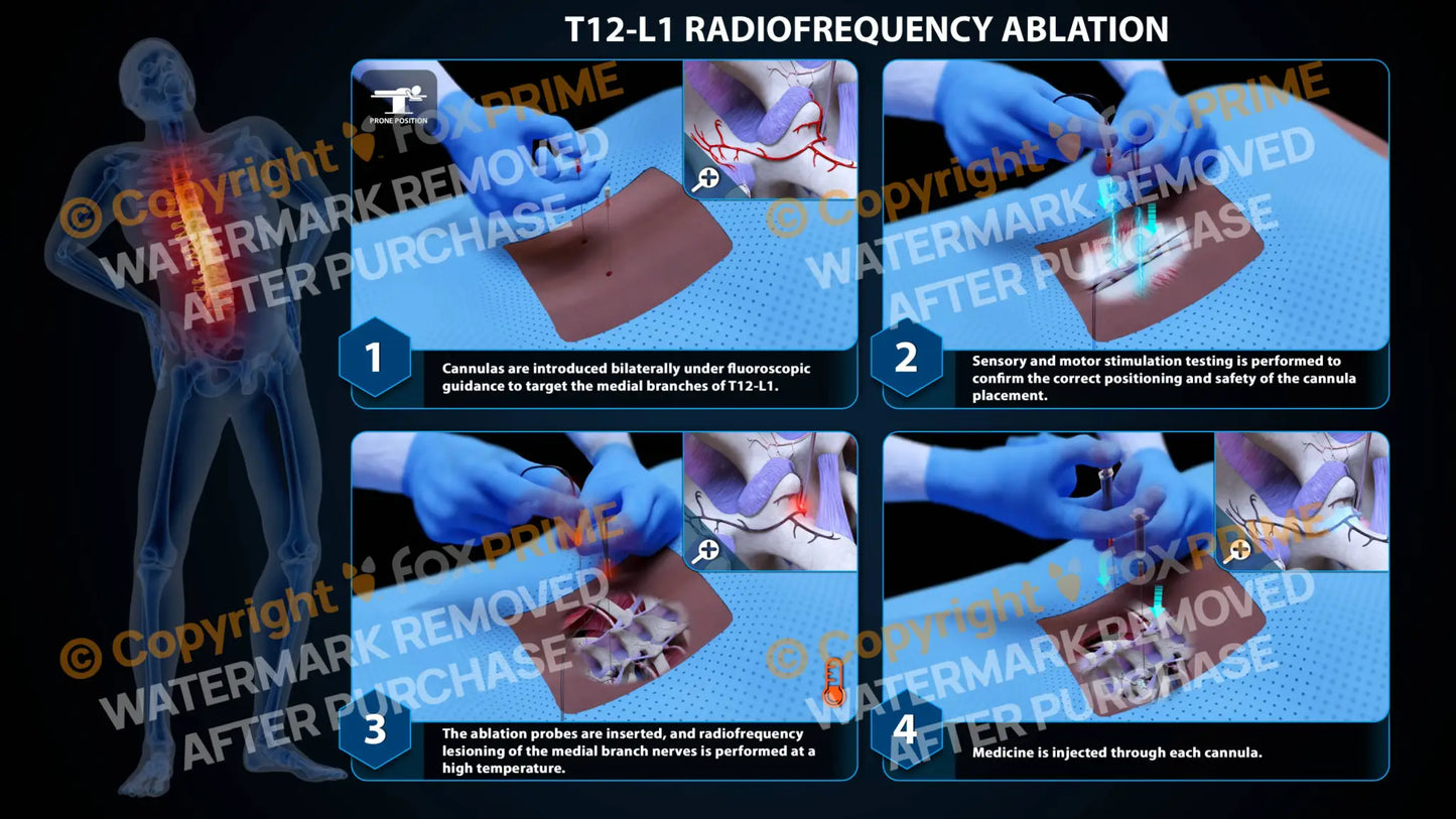 Bilateral Radiofrequency Ablation T12-L1 - Still Shot