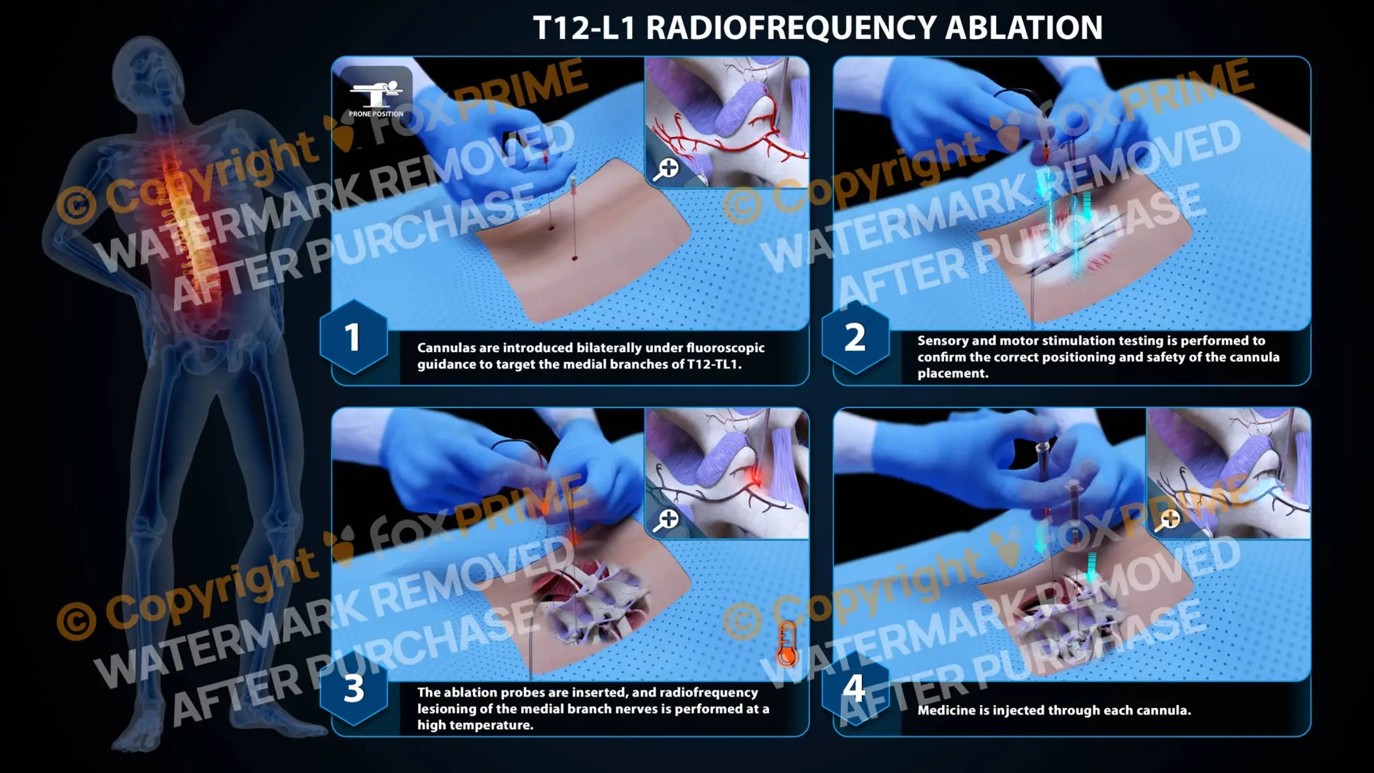 Bilateral Radiofrequency Ablation T12-L1 Still Shot