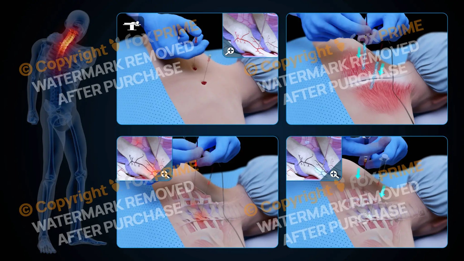 Bilateral Radiofrequency Ablation T2-T3 (No Text) - Still Shot