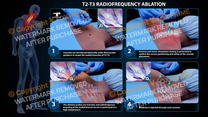 Bilateral Radiofrequency Ablation T2-T3 (PowerPoint) - PowerPoint