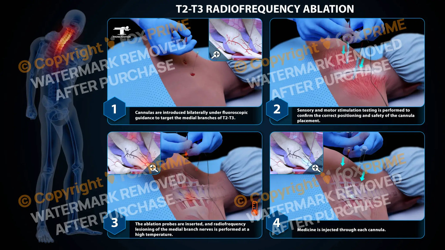 Bilateral Radiofrequency Ablation T2-T3 - Still Shot