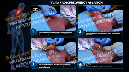 Bilateral Radiofrequency Ablation T2-T3 - Still Shot