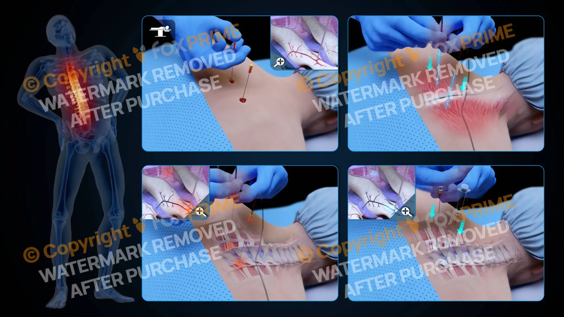 Bilateral Radiofrequency Ablation T3-T4 (No Text) - Still Shot
