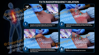 Bilateral Radiofrequency Ablation T3-T4 (PowerPoint) - PowerPoint