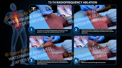 Bilateral Radiofrequency Ablation T3-T4 (PowerPoint) - PowerPoint