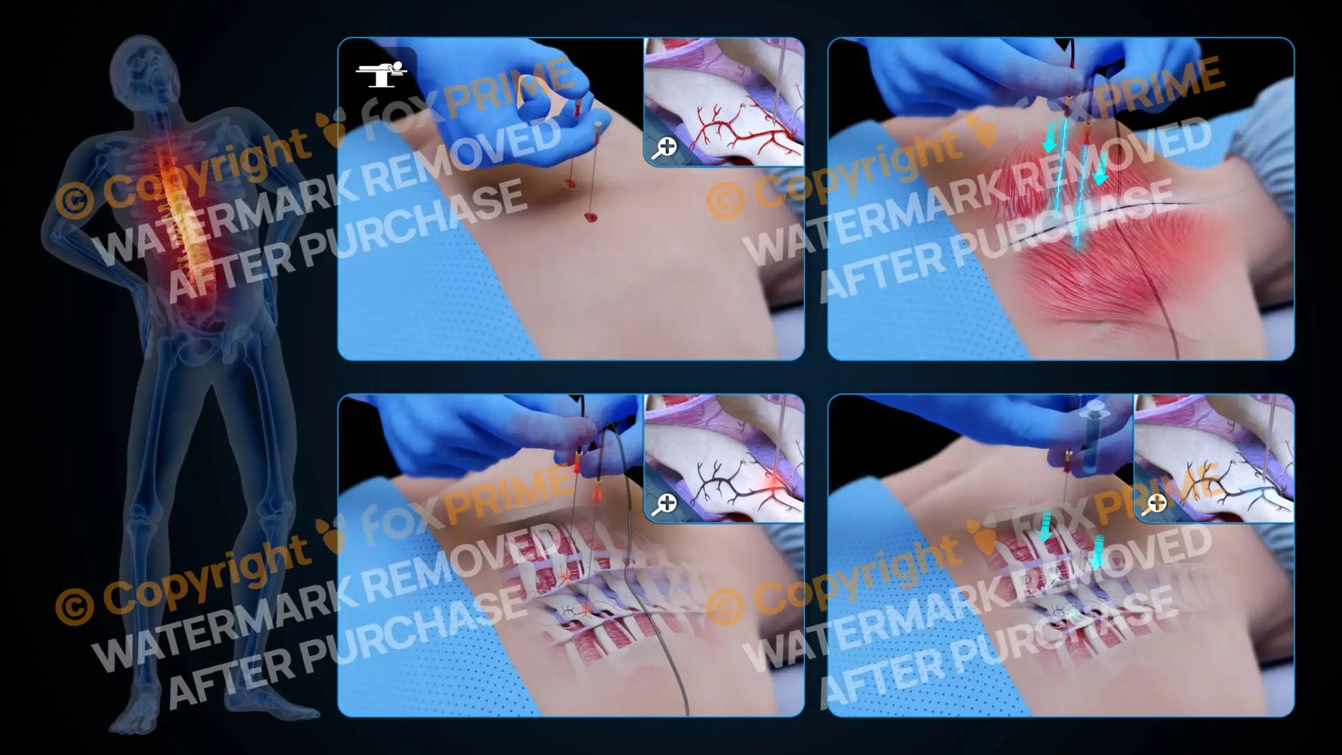 Bilateral Radiofrequency Ablation T4-T5 (No Text) - Still Shot