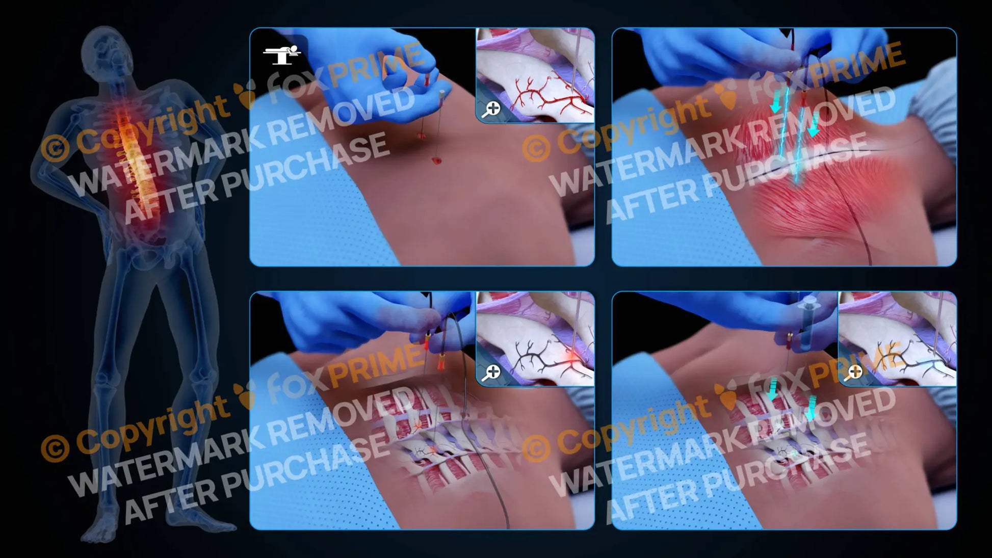 Bilateral Radiofrequency Ablation T4-T5 (No Text) - Still Shot