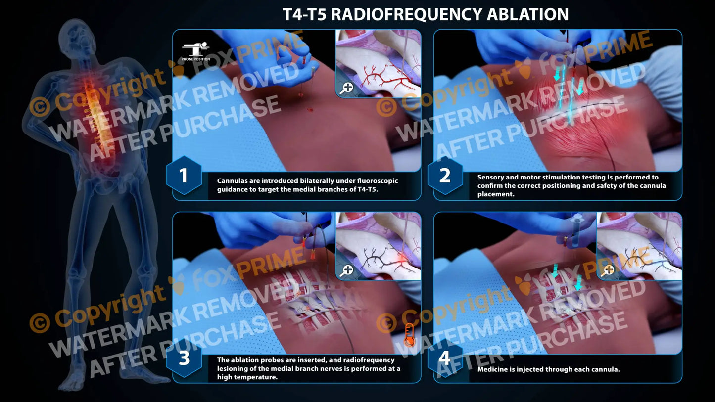 Bilateral Radiofrequency Ablation T4-T5 (PowerPoint) - PowerPoint