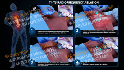 Bilateral Radiofrequency Ablation T4-T5 (PowerPoint) - PowerPoint