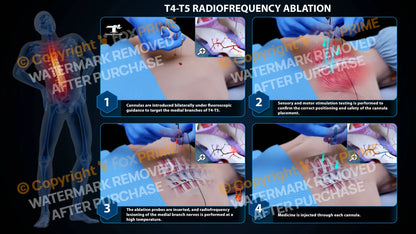 Bilateral Radiofrequency Ablation T4-T5 (PowerPoint) - PowerPoint