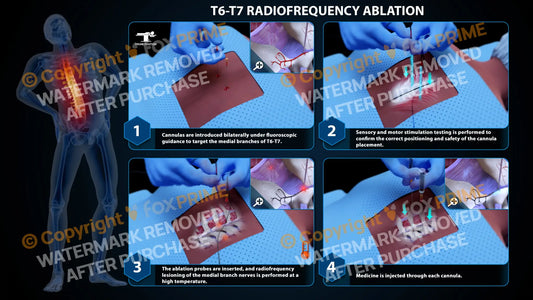 Bilateral Radiofrequency Ablation T6-T7 (PowerPoint) PowerPoint