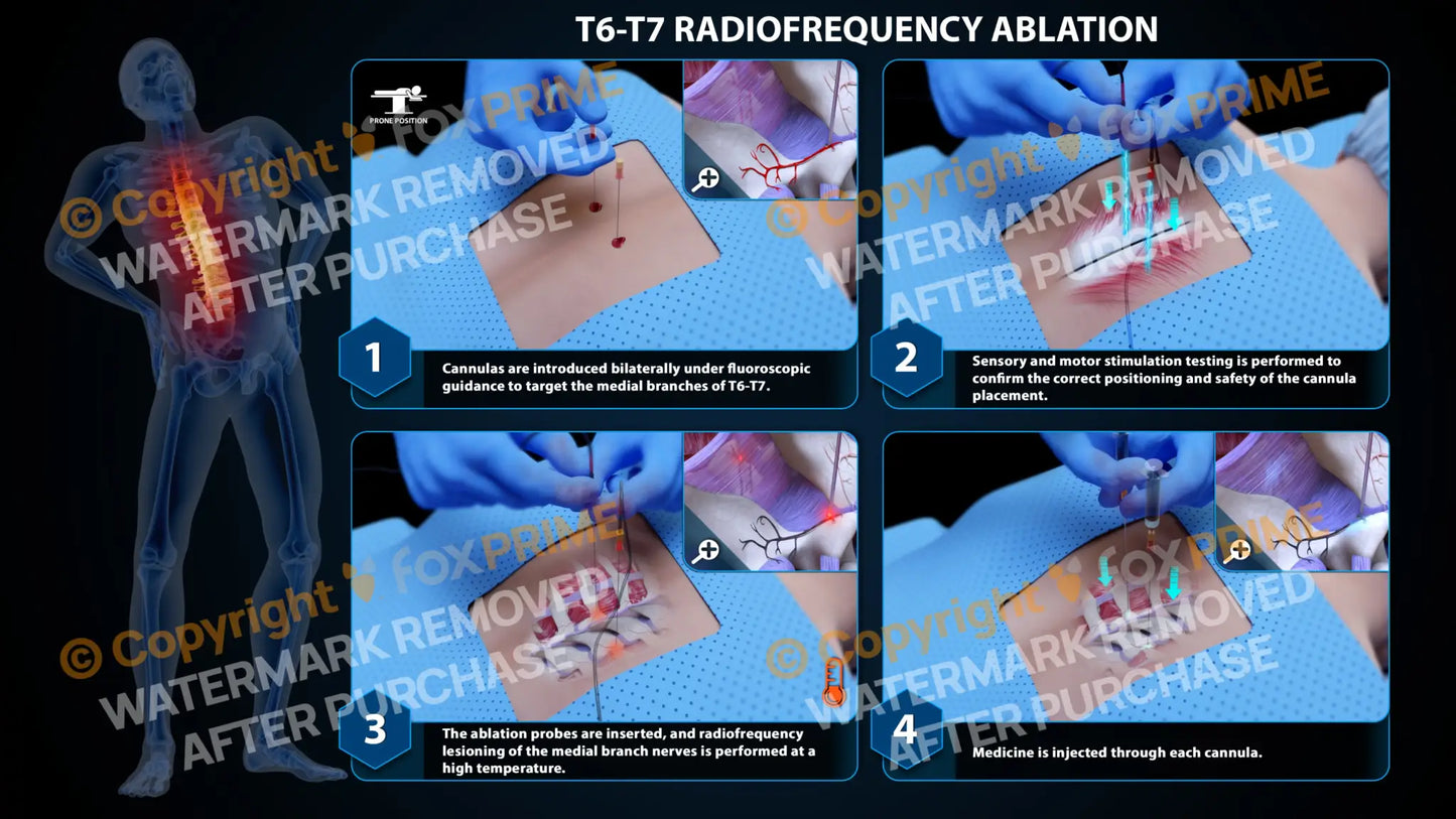 Bilateral Radiofrequency Ablation T6-T7 (PowerPoint) PowerPoint