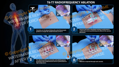 Bilateral Radiofrequency Ablation T6-T7 (PowerPoint) PowerPoint
